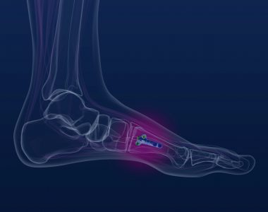 Produktabbildung Merete Foot Family - Fußchirurgie
