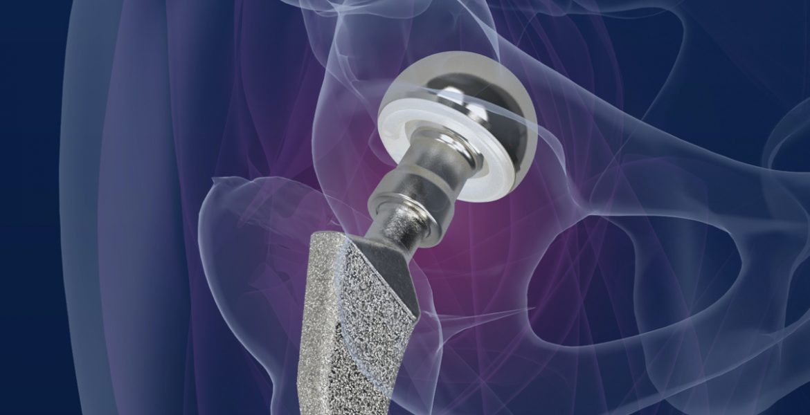 Ihr Partner für Hüftrevisionen Medizintechnik aus Berlin • Merete