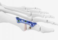 Implanted MetaFix™ MTP plate with external tension screw - foot surgery
