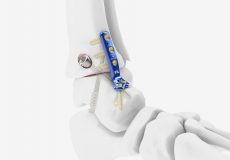 MetaFix™ TTF Plate implanted on hindfoot - foot surgery