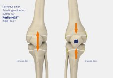 PediatrOS™ RigidTack™- Wirkprinzip des Implantats anhand der Darstellung kürzeres und längeres Bein - Kinderorthopädie